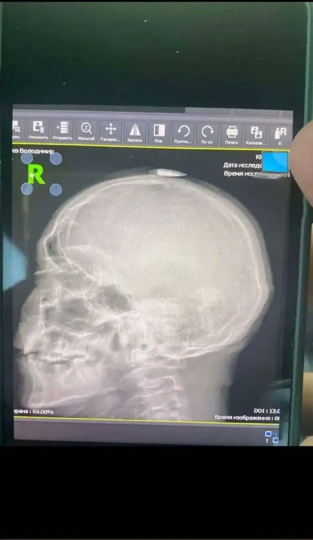 11 격렬한 전투후 거점으로 돌아온 우크라 병사 머리에 출혈이 있어 사진찍었더니 ㄹㅇ 간발의 차로 살았음.jpg